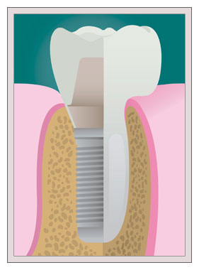 Dental Implants