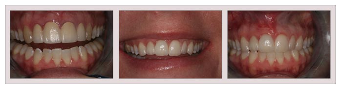 Dental Veneers